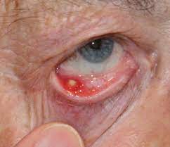 Brauchts am einen auge am wimperkranz entlang, am anderen in der lidfalte. Gerstenkorn Hagelkorn Auge Online