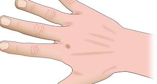 It also occurs in ankles and joints. 4 Common Types Of Hand Tumors The Hand Society