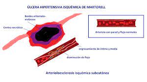 Ep.9 venous ulcer thank you for checking out our patient education videos. Key Elements To Understanding Martorell Ulcer Elena Conde Montero
