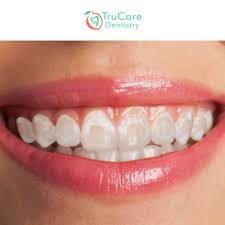 If you have white spots on your front teeth we know that they can be frustrating and you often find yourself wishing that they were not there. Post Braces Stains On Teeth Cause And Treatment Trucare Dentistry Roswell