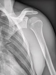 Image result for Shoulder XRay