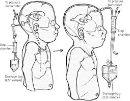 Ventriculoperitoneal Shunt Revision Neupsy Key