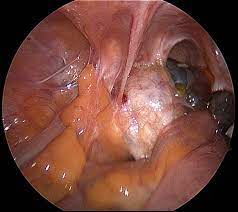 An der linden pj (1996). Endometriosis The Center For Innovative Gyn Care