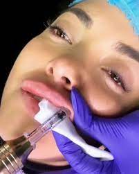 You can buy it directly from our store or a pro. Hyapen Pro Needleless Dermal Fillers And Fat Dissolve Elk Aesthetic