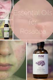 9 essential oil based recipes for rosacea
