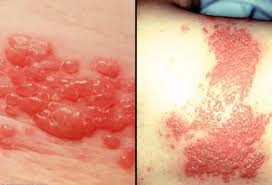 Image result for shingles in children