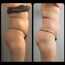 Cupped the only real solution after it dries and reached equilibrium moisture. 1 Ice Therapy W Wood Versatile Body Sculpting Spa Facebook