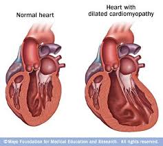 Dilated Cardiomyopathy Heart Disease Dilated Cardiomyopathy Heart Catheterization
