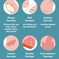 The immune system plays a key role in psoriasis. Psoriasis Symptoms And Complications