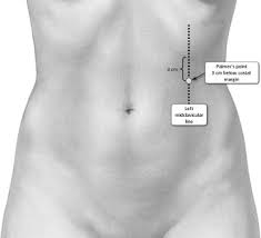 The universally preferred point of entry in previous surgery cases is the palmer's point developed by palmer. Are We Underutilizing Palmer S Point Entry In Gynecologic Laparoscopy Fertility And Sterility