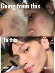 Healing My Acne Skin ✨😢