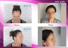 Le migliori 10 cliniche per il trapianto di capelli in turchia · dr. Trapianto Di Capelli Femminile