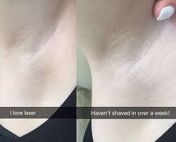 Using advanced laser technology we offer laser hair removal for men and women with dark and fair hair, providing up to 80% permanent hair reduction within eight to twelve treatments (approximately). Ipl Hair Removal Safe Permanent Dear Lashes
