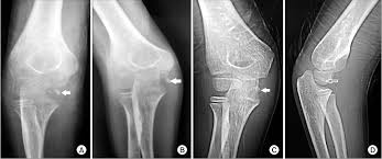 This is accomplished by inserting the needle into the tendon, then gently pushing down on the plunger while pulling the needle back. A Neglected Markedly Displaced Medial Epicondyle Fracture With Simultaneous Ulnar Nerve Palsy In An Adolescent Semantic Scholar
