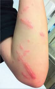 Herpes simplex viruses (hsvs) are dna viruses that cause acute skin infections and present as grouped vesicles on an erythematous base. Vesicular Rashes Visual Diagnosis And Treatment In Pediatrics 3 Ed
