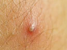 Dilute a little tea tree oil with water and use cotton swabs to apply it on the ingrown hair bumps on vagina. How To Get Rid Of Ingrown Hair Getridofthings Com