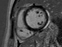 A position statement of the european society of cardiology working group on myocardial and pericardial diseases. Myocarditis Non Invasive Imaging Of Myocardial Muscle In Ventricular Tachycardia By Cardiac Mri Sciencedirect