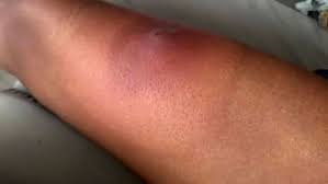 Image result for ant bite