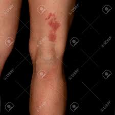 Unfortunately, shingles of the eye is rising dramatically, according to researchers at the university of michigan's kellogg eye center who found that the incidence has tripled since 2004. Herpes Zoster Or Shingles Rash On The Back Of The Leg Of A Middle Aged Stock Photo Picture And Royalty Free Image Image 140897183