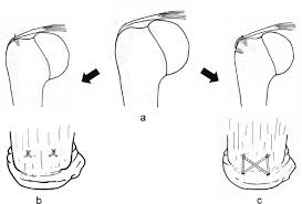 Arthroscopic Repair Of Partial Thickness Articular Surface Rotator Cuff Tears Single Row Transtendon Technique Versus Double Row Suture Bridge Transosseous Equivalent Fixation Results From A Prospective Randomized Study Springerlink