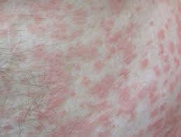 Morbilliform Drug Reaction Dermnet Nz