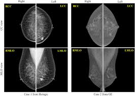 Image result for Mammogram Interpretation