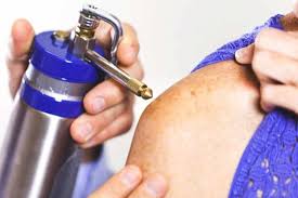 Can You Freeze Off A Mole How Long Until It Falls Off Skin Care Geeks