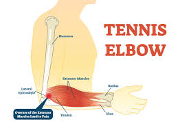 The motion of the arm and the wrist will strain the tendons in the elbow. What Is Tennis Elbow And What Can I Do About It Ask The Team At Motionworks Physiotherapy In Stittsville Near Ottawa