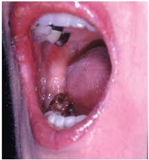 There is a lot of misinformation about herpes, both among health providers and the general public. A Collection Of Herpes Manifestations And Herpes Associated Syndromes Consultant360