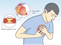 Banyak cara merawat tanaman yang efektif supaya tanaman tidak mudah terserang penyakit. Bagaimana Cara Hilangkan Sakit Jantung Dan Kolestrol Tinggi Dalam Badan