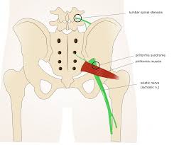 Diagram representing the posterior view of the insertion points of the quadriceps muscles and the origins of the leg muscles. Piriformis Syndrome