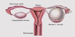 как лечить воспаление яичников у женщин в домашних условиях Kak Lechit Kistu Yaichnika V Domashnih Usloviyah
