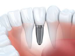 A lot of people avoid dental implants because they have been made to believe they are painful to have in the mouth. Root Canal Vs Implant Which Is Best Fermelia Dental