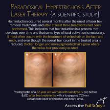 Many women are concerned about skin discoloration with hair removal. About Laser Hair Removal Electrolysis Beauty Lounge