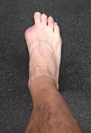 Image result for toe amputation