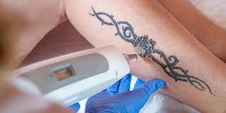 After your treatment, usual activities can resume, just keep the area clean! 6 Things Everyone Gets Wrong About Laser Tattoo Removal Self