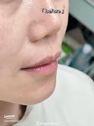 ฟิลเลอร์ปาก 1 cc แค่ไหนถึงสวย!