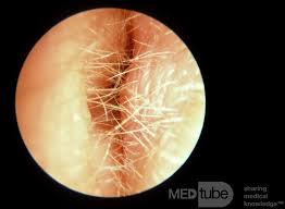 Image result for Acute Otitis Externa