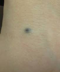 Image result for Blue Nevus