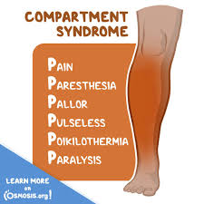 Image result for Compartment Syndrome