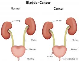 Symptoms include blood in the urine, pain with urination, and low back pain. What Causes Bed Wetting In Adults With Pictures