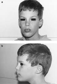 A New Neurological Syndrome with Mental Retardation, Choreoathetosis, and  Abnormal Behavior Maps to Chromosome Xp11