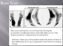 Image result for Osteomyelitis Bone Scan