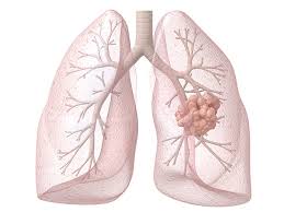 When you first hear you have cancer, you think you're a gonner, and then you learn that this can be a chronic disease. Ak8krkp2edkejm