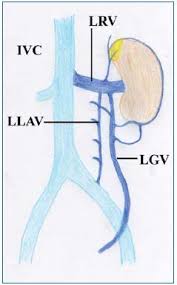 Nutcracker Syndrome Servier Phlebolymphologyservier Phlebolymphology