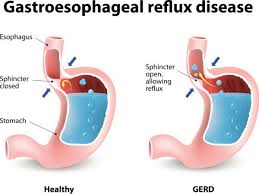 Acid reflux occurs when the acidic contents of the stomach flow into the esophagus. Best Homeopathy Cure For Gerd Gastro Esophageal Reflux Disorder At Life Force Clinics In Mumbai Pune And Bangalore