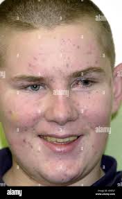 Stephen Menary, the 14 year old boy who was badly injured by a terrorist  bomb,