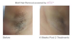 Performed by trained professionals in a private clinic, our laser hair removal treatments are fast, effective and affordable! Laser Hair Removal San Antonio Laser Hair Clinic