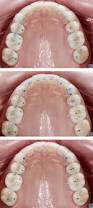 Image result for Occlusal