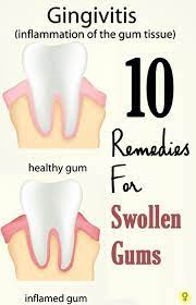 14 Home Remedies To Treat Swollen Gums Causes And Prevention Swollen Gum Gum Health Teeth Health